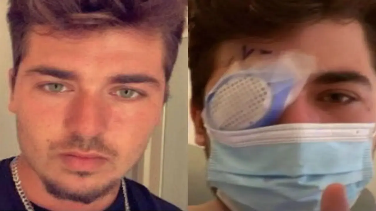 Dormir con lentes de contacto desencadenó una infección que le quitó la visión